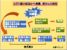 ピロリ菌の感染から胃潰瘍（十二指腸潰瘍）、胃がんへ