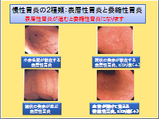 慢性胃炎は、表層性胃炎と委縮性胃炎の2種類
