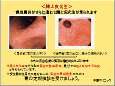 慢性胃炎（委縮性胃炎）が進行すると腸上皮化生に